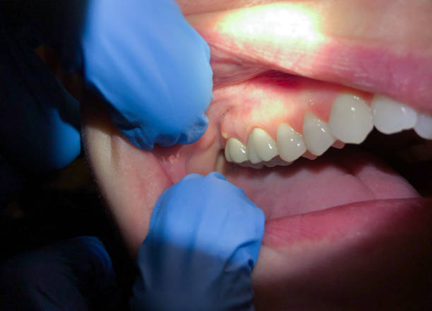 Best Dentist for Tooth Abscess  in Jemez Pueblo, NM